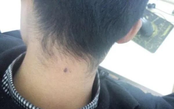 后脖有痣的男人好吗 有什么讲究